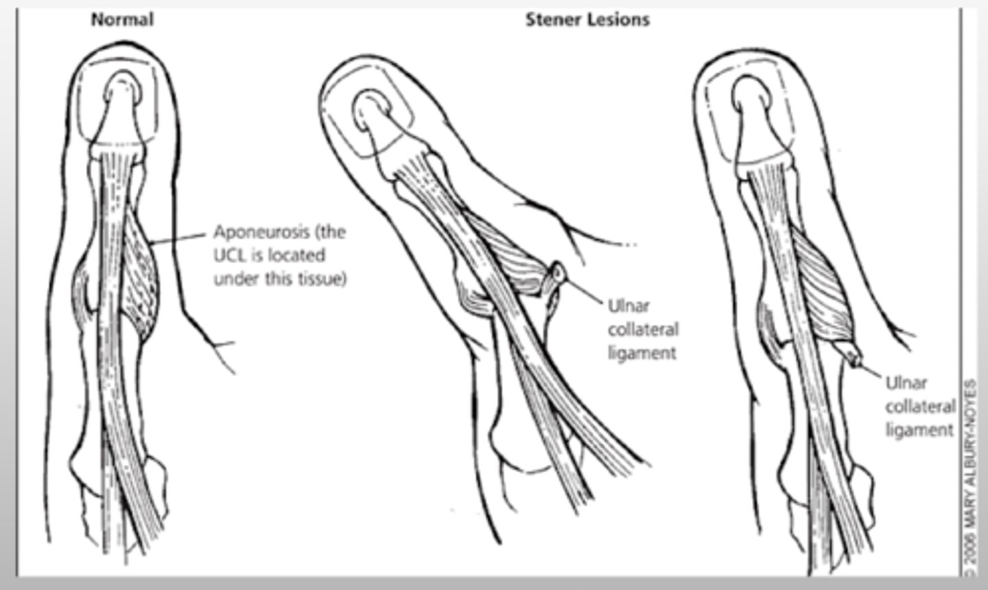 <p>Skier's thumb</p><p>MCP dislocation</p>