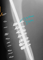 <p><span style="background-color: transparent;"><strong>Cerclage Wire</strong></span></p>