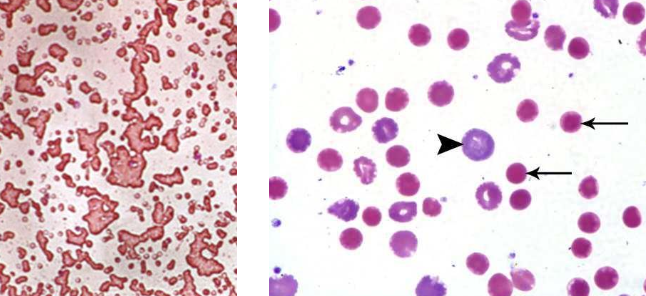 <p>-removal/treatment of tumor</p><p>-immune suppression</p>
