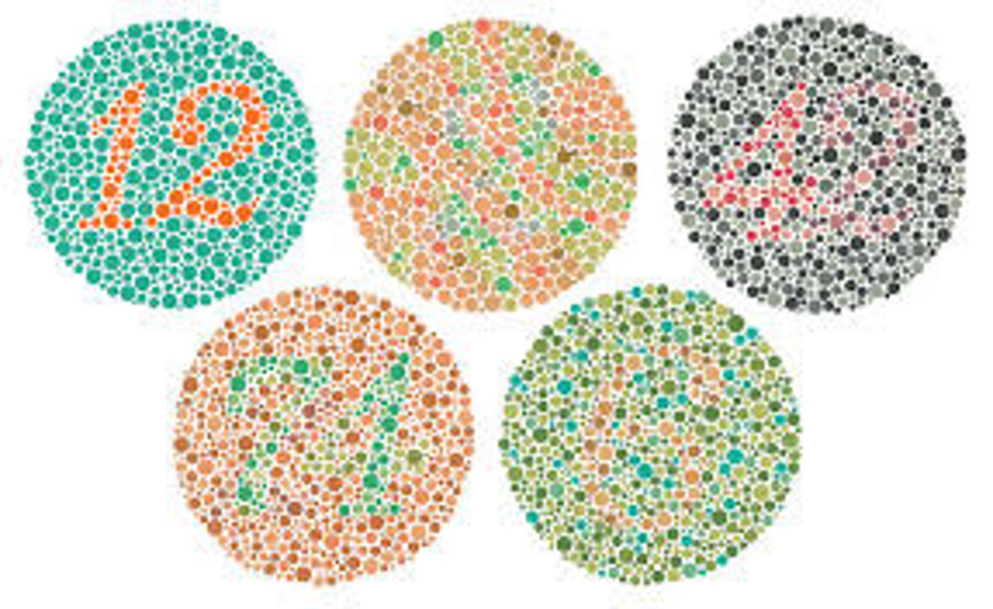 <p>An inability to see certain colors due to a lack of one or more types of cones; Caused by recessive gene on x-chromosome (more common in males). Tested by presenting patient with a pattern of colored circles, most common type is red-green</p>