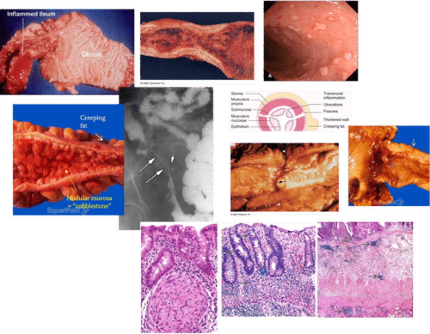 <p>Define Condition:</p><p>Transmural inflammation involving ileum, but may involve any area of GI tract</p><p>-Hx:</p><p>&gt; FEMALES</p><p>&gt; Smoking</p><p>&gt; FHx</p><p>-Path:</p><p>&gt; Genetics = D/t NOD2 gene (protein for defending against intestinal bacteria) mutation -&gt; ↑intestinal bacteria to penetrate past epithelium -&gt; trigger inflammatory reactions</p><p>&gt; Immune Defect = Defect in Th1 T-Cells --&gt; Cytokine mediated chronic inflammation</p><p>&gt; Cell Defect - Defects in intestinal epithelial tight junction barrier function</p><p>-Sx/PE:</p><p>&gt; Intermittent RUQ Pain</p><p>&gt; Watery/Non-Bloody Diarrhea</p><p>&gt; Weight Loss</p><p>&gt; Deficiencies:</p><p>&gt;&gt; Vit Deficiency fat soluble vitamins (ADEK) = Duodenum, Jejunum, Ileum</p><p>&gt;&gt; Folate Deficiency = Jejunum</p><p>&gt;&gt; Iron Deficiency = Duodenum &amp; Upper Jejunum</p><p>&gt;&gt; Vit B12 &amp; Bile Acid Deficiency = Terminal Ileum (Impaired absorption --&gt; Fat malabsorption ==&gt; Steatorrhea)</p><p>-Dx:</p><p>&gt; (+) ASCA (Anti-Saccharomyces cerevisiae Abs)</p><p>&gt; Endoscopy:</p><p>&gt;&gt; "Cobblestone" Deep Ulcers: Ileal stricture w/ effaced folds, heaped-up nodular mucosa</p><p>&gt;&gt; Fat Wrapping/Creeping Fat: Transmural inflammation heals --&gt; Condensed mesentery tissue pulls fat around bowel</p><p>&gt;&gt; Segmental "Skip" Lesions</p><p>&gt;&gt; Strictures: Marked thickening of bowel wall (transmural inflammation) --&gt; Stenosis of Lumen (stricture)</p><p>&gt;&gt; Fistulas: Transmural inflammation --&gt; Fissures --&gt; Extends deep ==&gt; Fistula tracts</p><p>&gt;&gt; Right-sided predominance:</p><p>&gt;&gt;&gt; MC = Terminal ileum</p><p>&gt;&gt;&gt; Only SI = 40%</p><p>&gt;&gt;&gt; SI and Colon = 30%</p><p>&gt;&gt;&gt; Only Colon = 30%</p><p>&gt;&gt; Rectum-sparing (1/3 of cases) - can have oral involvement (aphthous ulcers) and anal involvement (fistulae)</p><p>&gt; Imaging: "String Sign"</p><p>&gt;&gt; D/t severe narrowing from edema + spasm + fibrosis</p><p>&gt;&gt; Frequently a/w Proximal Dilation</p><p>&gt; Biopsy: Non-caseating granulomas + Crypt Abscesses</p><p>-Prog:</p><p>&gt; Colon Cancer (need colonoscopy &amp; Bx every 2-3 yrs after 8 yr Dx)</p><p>&gt;&gt; PSC --&gt; HIGH RISK of Colon Cancer</p><p>&gt; Small Bowel ACA</p><p>&gt; Anal Cancer</p>
