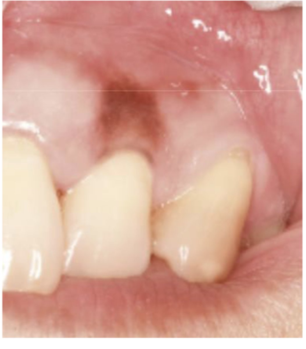<p>What type of pigmented lesion?</p>