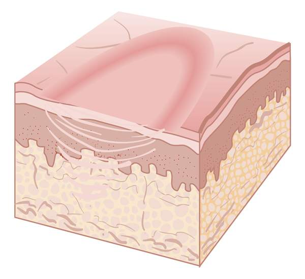 <p>loss of a portion of the skin</p>