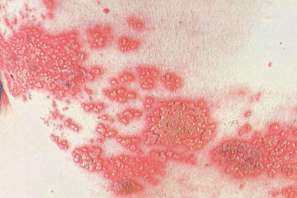 <ul><li><p><span style="line-height: inherit; font-size: inherit;">Warts are small, raised skin growth caused by human papilloma virus.</span></p></li><li><p><span style="line-height: inherit; font-size: inherit;">Cold sores are caused by herpes simplex virus type 1 and manifest as painful ulcers along the gumlines of the mouth or on the lips.</span></p></li><li><p><span style="line-height: inherit; font-size: inherit;">Shingles is an acute inflammatory disorder caused by herpes zoster virus and is characterized by a painful rash on the trunk of the body and occasionally on the face. Herpes zoster tends to follow the dermatomes.</span></p></li><li><p><span style="line-height: inherit; font-size: inherit;">Treatment includes analgesic and antipruritic medications. Vaccines can help prevent shingles.</span></p></li><li><p><span style="line-height: inherit;">The common viral skin infections include warts, herpes simplex (cold sores), and herpes zoster (shingles)</span></p></li></ul><p></p>