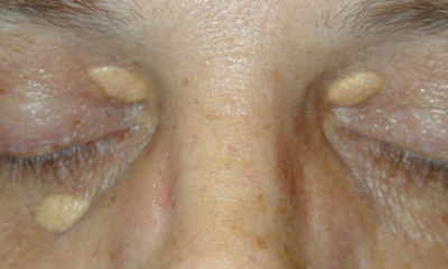 <p>Xanthoma</p>