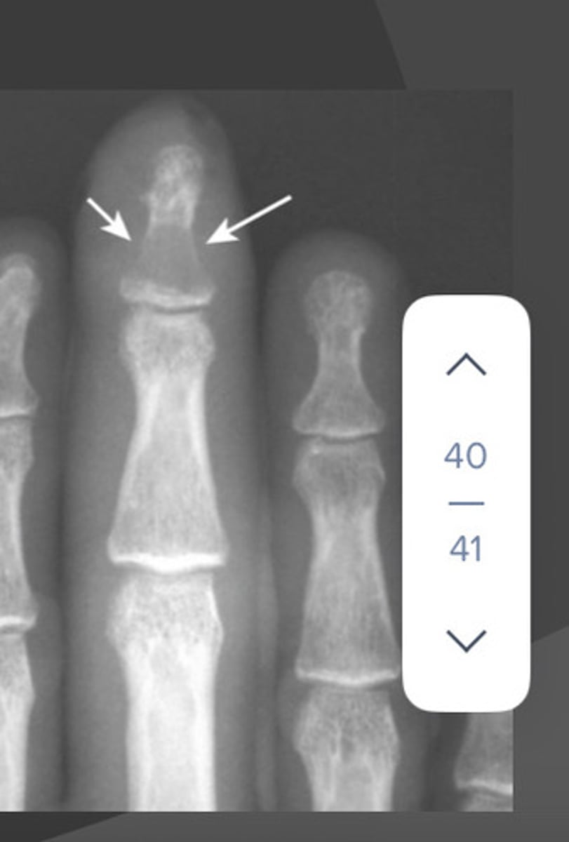 <p>- Focal cortical bone destruction</p><p>- Soft tissue inflammation</p>