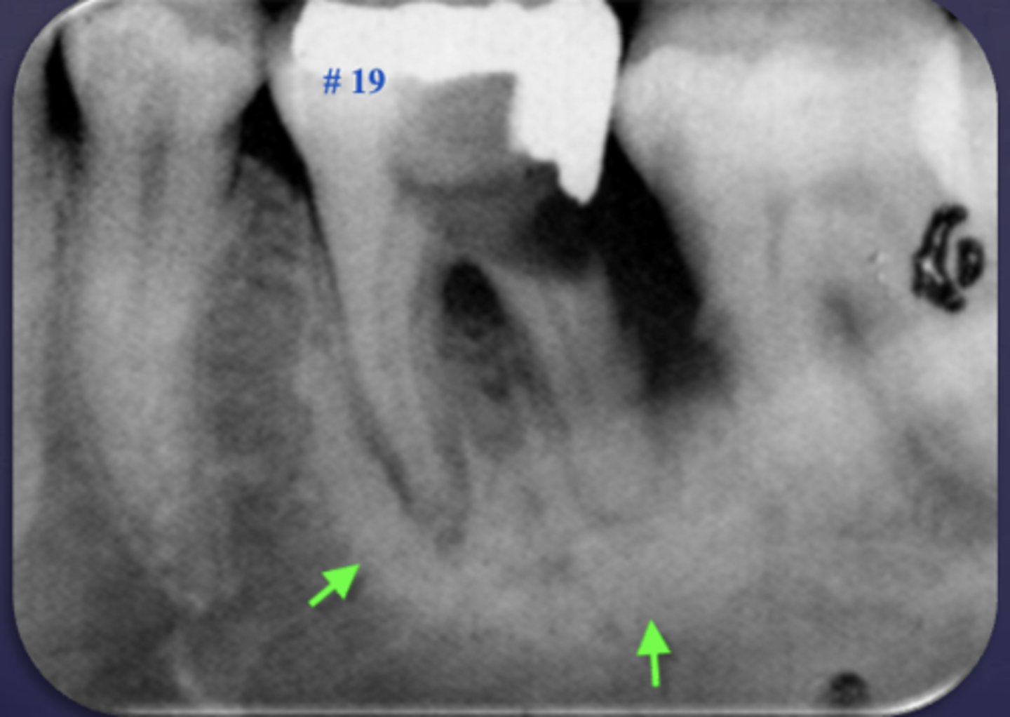 <p>Sclerosing osteitis or dense bone island?</p>