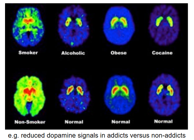 <p>It detects changes in the brain’s blood flow by measuring changes in the uptake of compounds such as <span>oxygen, glucose, neurotransmitters, proteins</span> (indirectly measures neural activity).</p><ul><li><p>Often combined with CT, MRI (better imaging) or EEG (better timing).</p></li></ul><p></p>