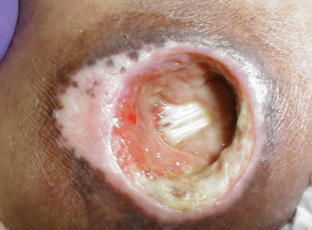 <p>pressure injury stage</p>