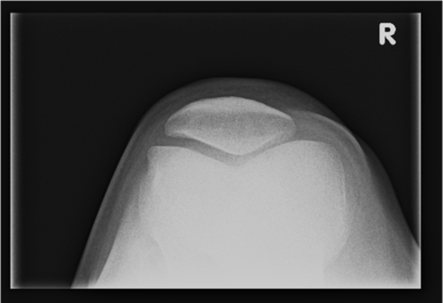<p>Sunrise knee projections help see the _____</p>