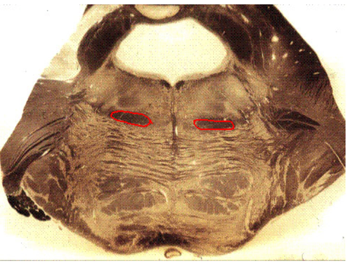 <p>second order neurons in the main sensory nucleus and spinal nucleus of trigeminal nerve and decussate</p>