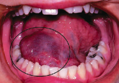 <p>located in the <span style="color: red;">floor of the mouth</span></p><p>essentially a type of mucocele in this specific location</p><p>a <span style="color: red;">mucous extravasation phenomenon</span> associated with the <span style="color: red;">submandibular or sublingual glands</span></p>