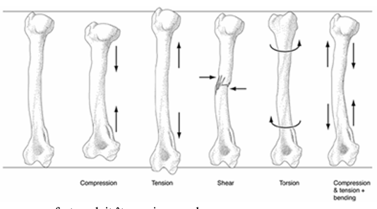 <p><strong>Force de compression</strong> (Raccourcit l’os) → Comminutive et Oblique (Car compression est à l’origine force de cisaillement)</p><p><strong>Force de tension</strong> (Allonge l’os) → Transverse</p><p><strong>Force courbe/flexion</strong> (Courbe l’os) → Transverse (Côté en tension vers côté compressé)</p><p><strong>Force de torsion </strong>(Déforme l’os en rotation) → Spiral </p>
