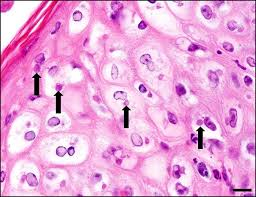 <p>The presence of intracytoplasmic</p><p>inclusion bodies along with central nuclear clearing</p><p>in affected epithelial cells is a hallmark sign of this disease. </p>