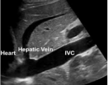<p>How would the IVC appear in the case of euvolemia?</p>
