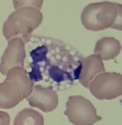 <ul><li><p>vacuoles in the cytoplasm of segmented neutrophils</p></li><li><p><u>caused by prolonged exposure to drugs or storage time</u> (storage time causes pseudo-vacuolization)</p></li><li><p><strong>usually a sign of serious infection or sepsis</strong></p></li></ul><p></p>