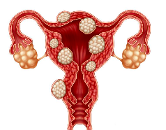 <p>endometriosis</p>