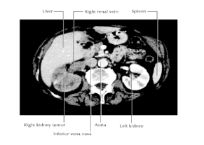 <p><span><span>Renal cell carcinomas:</span></span></p><ul><li><p><span><span>Grow outward of the kidney into fat &amp; fascia</span></span></p></li></ul><p></p><p>Patient Presentation:</p><ul><li><p><span><span>Most patients complain of blood in the urine (hematuria), pain in the infrascapular region (loin), and a mass.</span></span></p></li></ul><p></p><p>Complication:</p><ul><li><p><span><span>invade the renal vein Spread to the inferior vena cava, right atrium, and across the tricuspid valve into the pulmonary artery.</span></span></p></li></ul><p></p>
