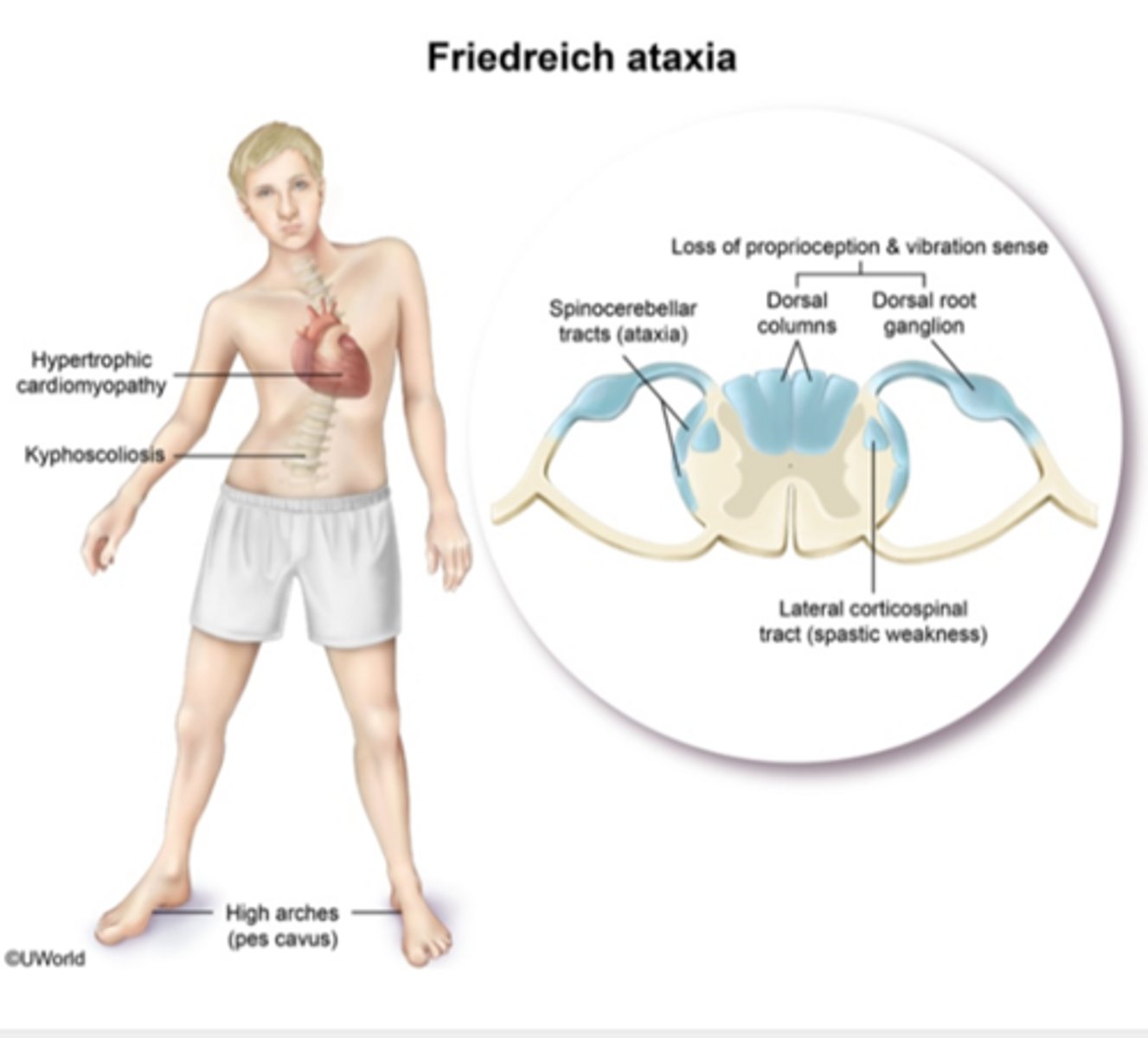 <p>gait ataxia → followed by slurring dysarthria and nystagmus</p><p>NO vertigo</p>