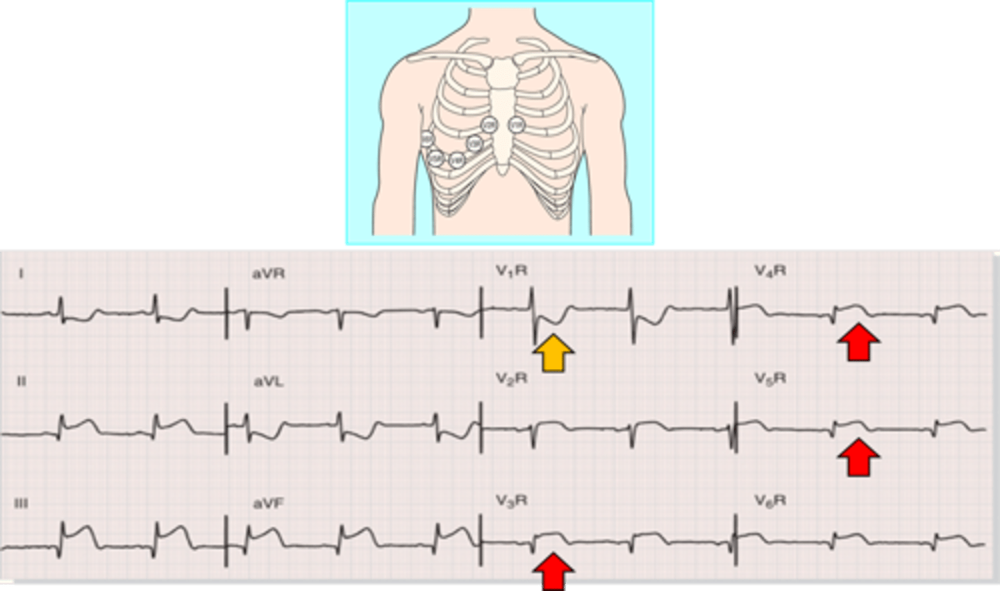 <p>- ST elevation in V1 </p><p>- ST elevation in lead III&gt;lead II </p><p>- ST elevation in V1&gt;V2 </p><p>- ST elevation in V1 and ST depression in V2 (highly specific) </p><p>- ST elevation in V3R and V6R </p>