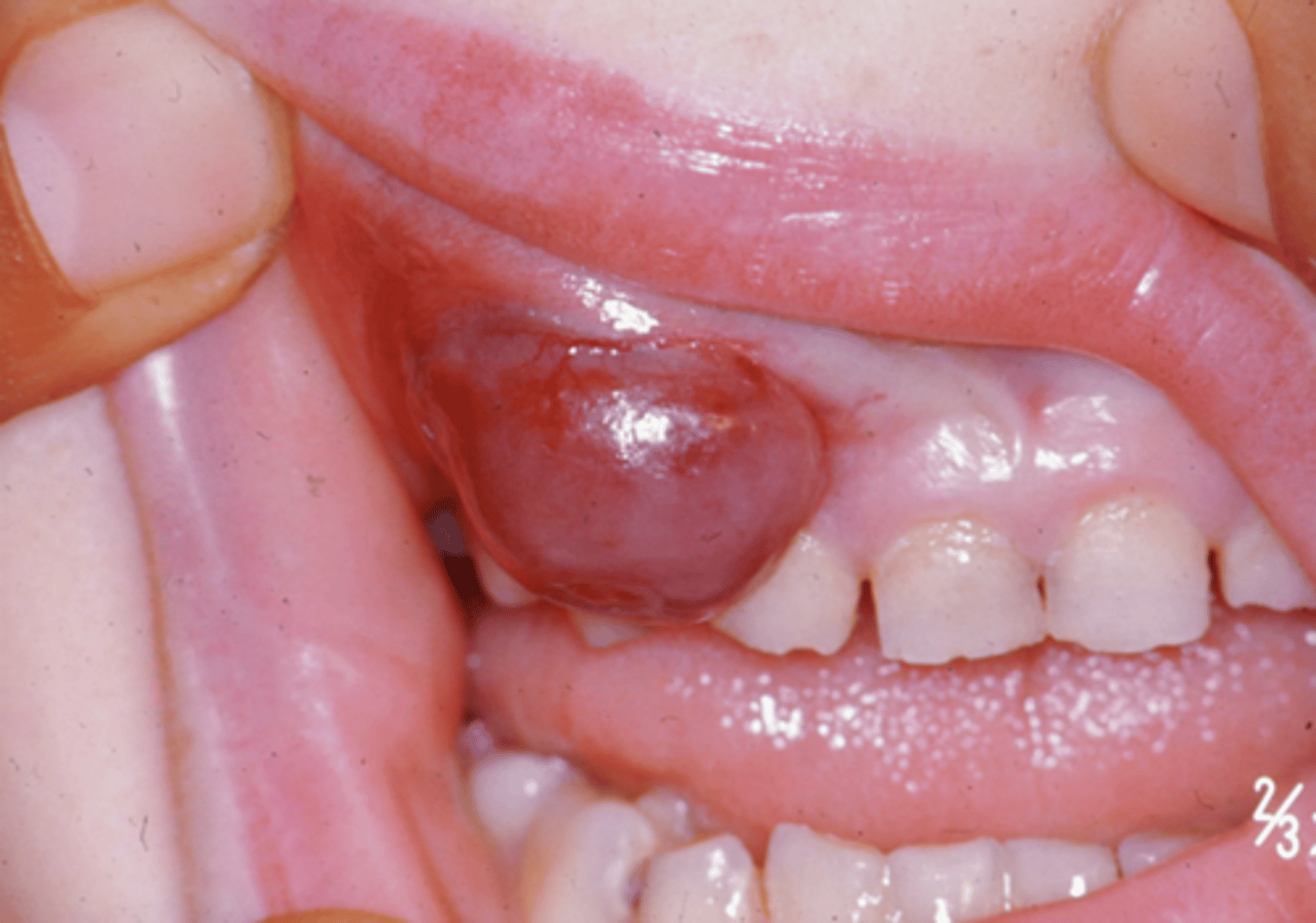 <p>large reddish/purple benign lesion that contain multinucleated giant cells and fibroblasts</p>