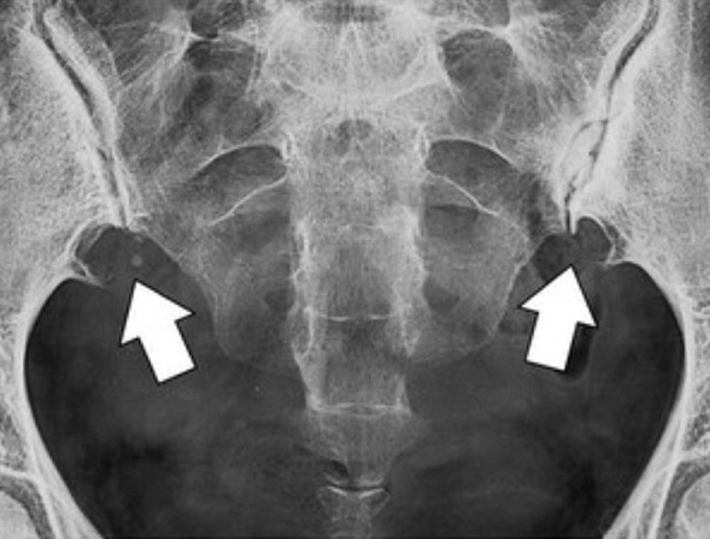 <p>Note: nearly exclusively seen in females</p>