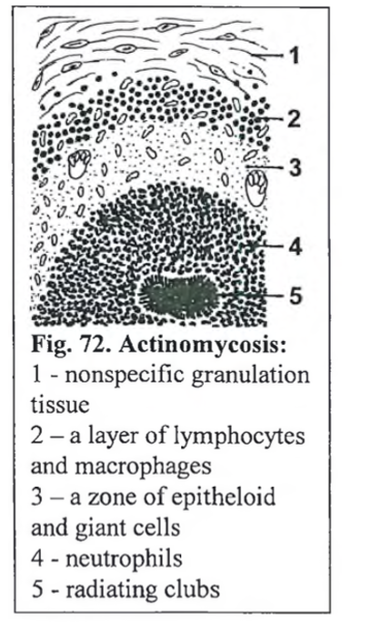 <p><strong>Actinomycosis </strong>(most often mandibular, less frequent maxilla) - <em>Bildet e mest sannsynlig maxilla</em></p><img src="https://knowt-user-attachments.s3.amazonaws.com/6a977b97-82df-4669-abe8-a002c04590fb.png" data-width="100%" data-align="center"><p></p>
