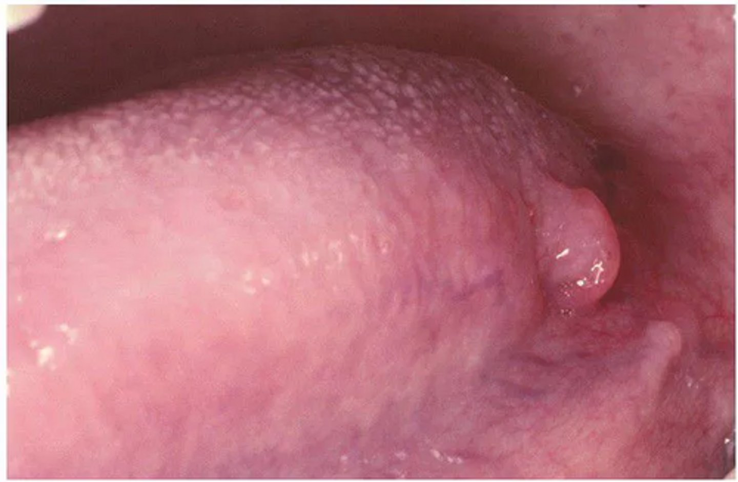 <p>A lesion on the posterior lateral tongue appears bulbous and slightly lighter than surrounding tissue. It is asymptomatic.</p><p>What is the most likely diagnosis?</p>