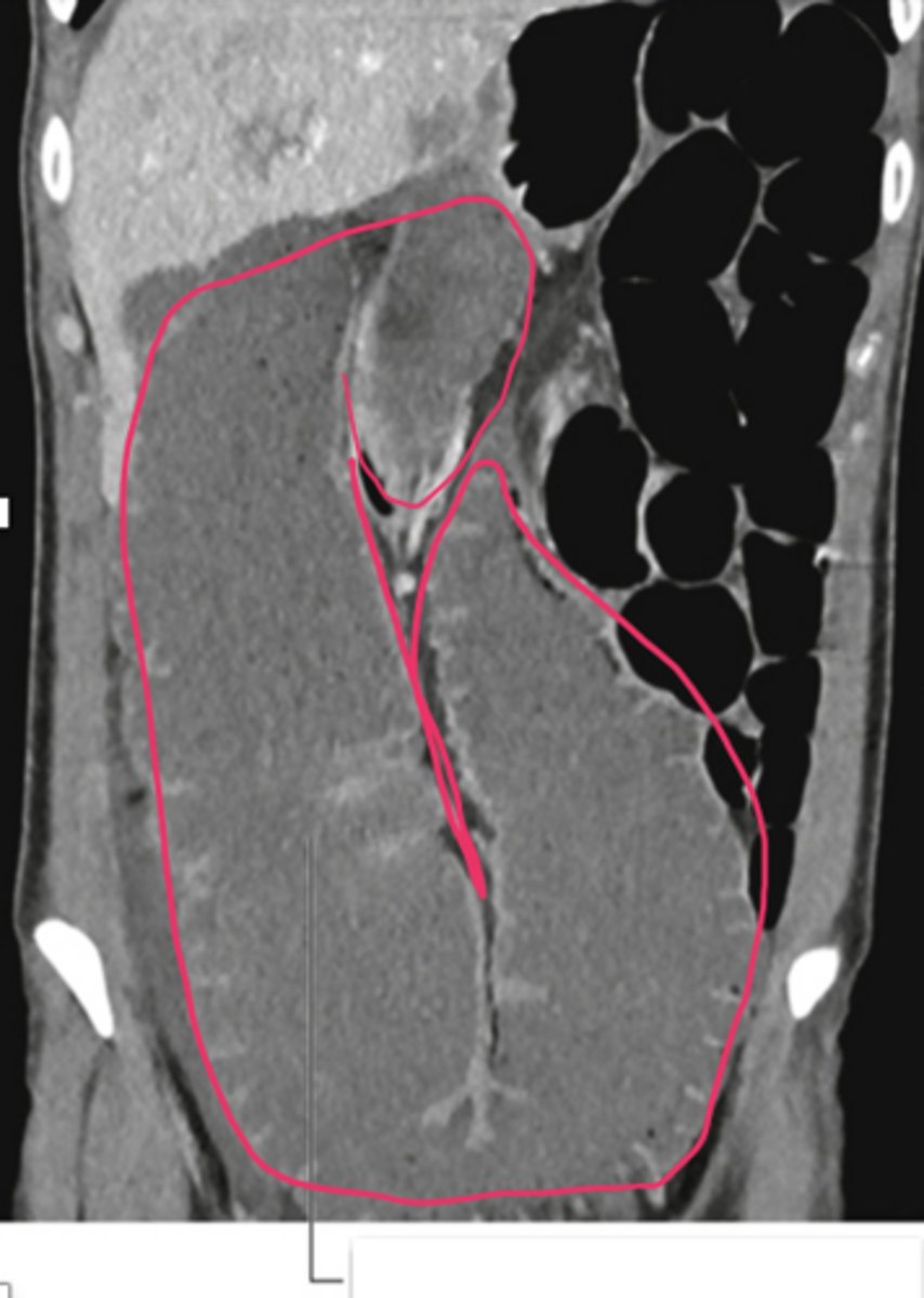 <p>Large colon due to bowl obstruction</p>