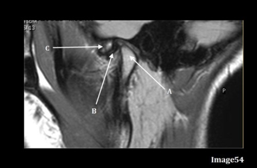 <p>Image 54 is an MRI of the ______.</p><p>A. Shoulder joint</p><p>B. Hip Joint</p><p>C. TMJ</p><p>D. Pituitary gland</p>