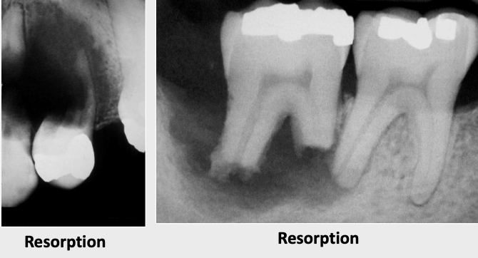<p>Observed radiographically when the apex of the tooth appears shortened or blunted and irregularly shaped; occurs as a response to stimuli, which can include a cyst, tumor, trauma, malignancy</p>