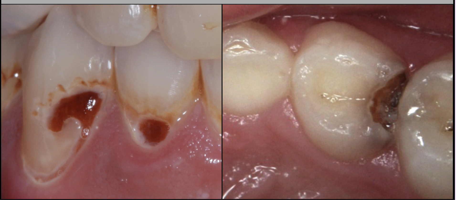 <p><span style="background-color: transparent;"><span>Tooth has a birthday on September 12, what is its ICDAS?</span></span></p>