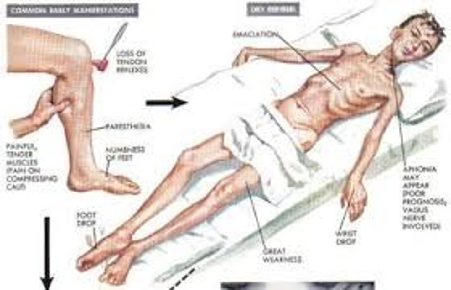 <p>Beriberi & Wernicke-Korsakoff syndrome</p>