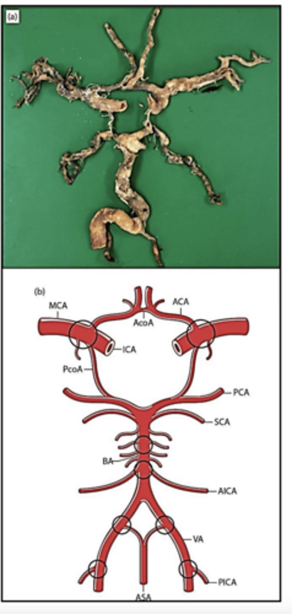 <p>Circle of Willis with the most common sites for atheroma circled:</p>