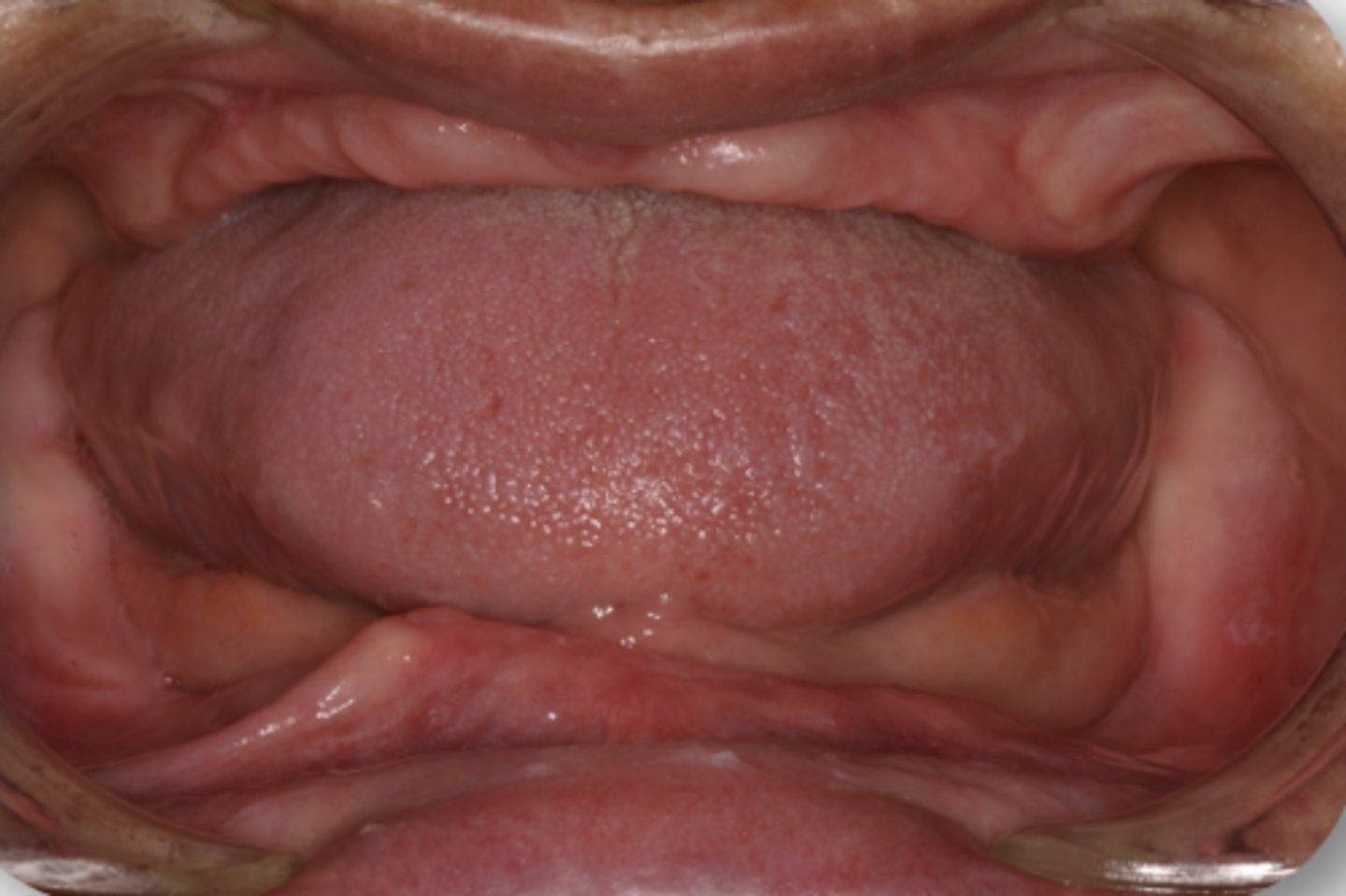 <p>In a denture bearing area, there is about ___square centimeters of <strong>support</strong> in the <u>maxilla</u></p>