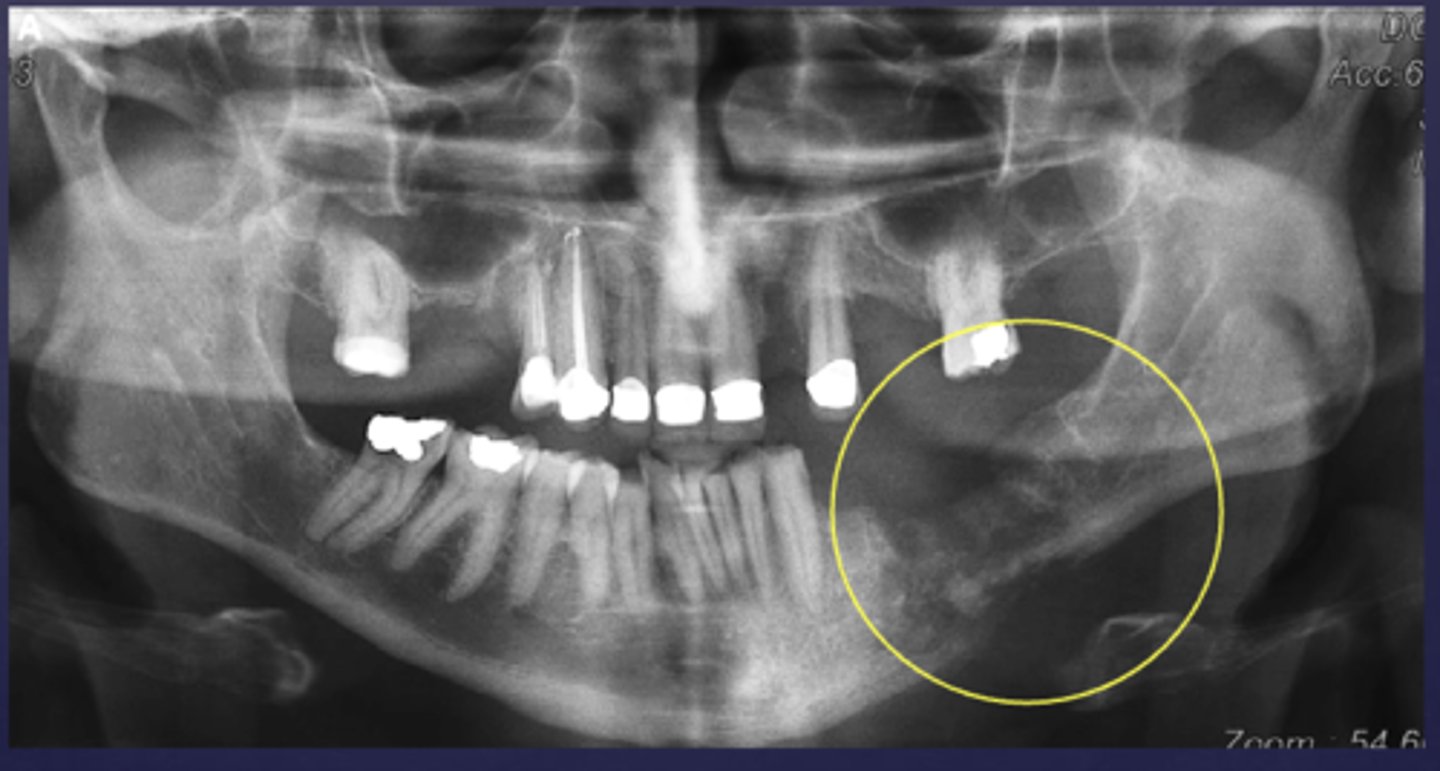 <p>What phase of osteomyelitis?</p>