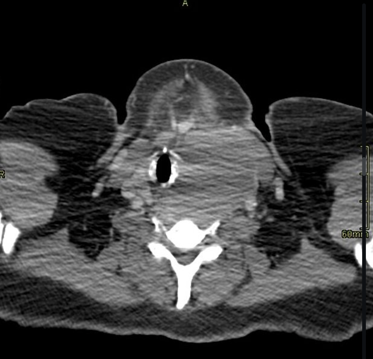 <p>What type of thyroid nodule is this - rare, associated with Hashimoto’s thyroiditis</p>