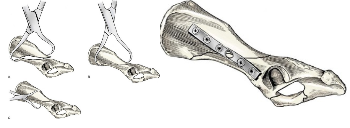 <ol><li><p>Lateral bone plate placement</p><ol><li><p>Bone forceps &amp; rotational movement to counteract overlap of oblique fragments</p></li></ol></li></ol><p></p>