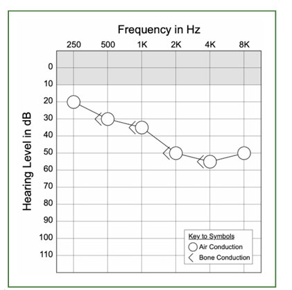 <p>normal, conductive, senso?</p>
