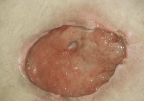 <p>A PT is treating a patient, who was originally diagnosed with a pressure injury stage 3. The patient presents to the lcinic with ulcer shown below. Which of the following is true?</p><ol><li><p>The pressure injury is now an unstageable ulcer</p></li><li><p>The pressure ulcer is now a stage 1 ulcer</p></li><li><p>The pressure ulcer is now a stage 2 ulcer</p></li><li><p>A pressure ulcer can not be back-staged</p></li></ol><p></p>