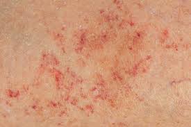 <p><span>A visible small collection of blood in the skin smaller than 0.5cm in diameter.</span></p>