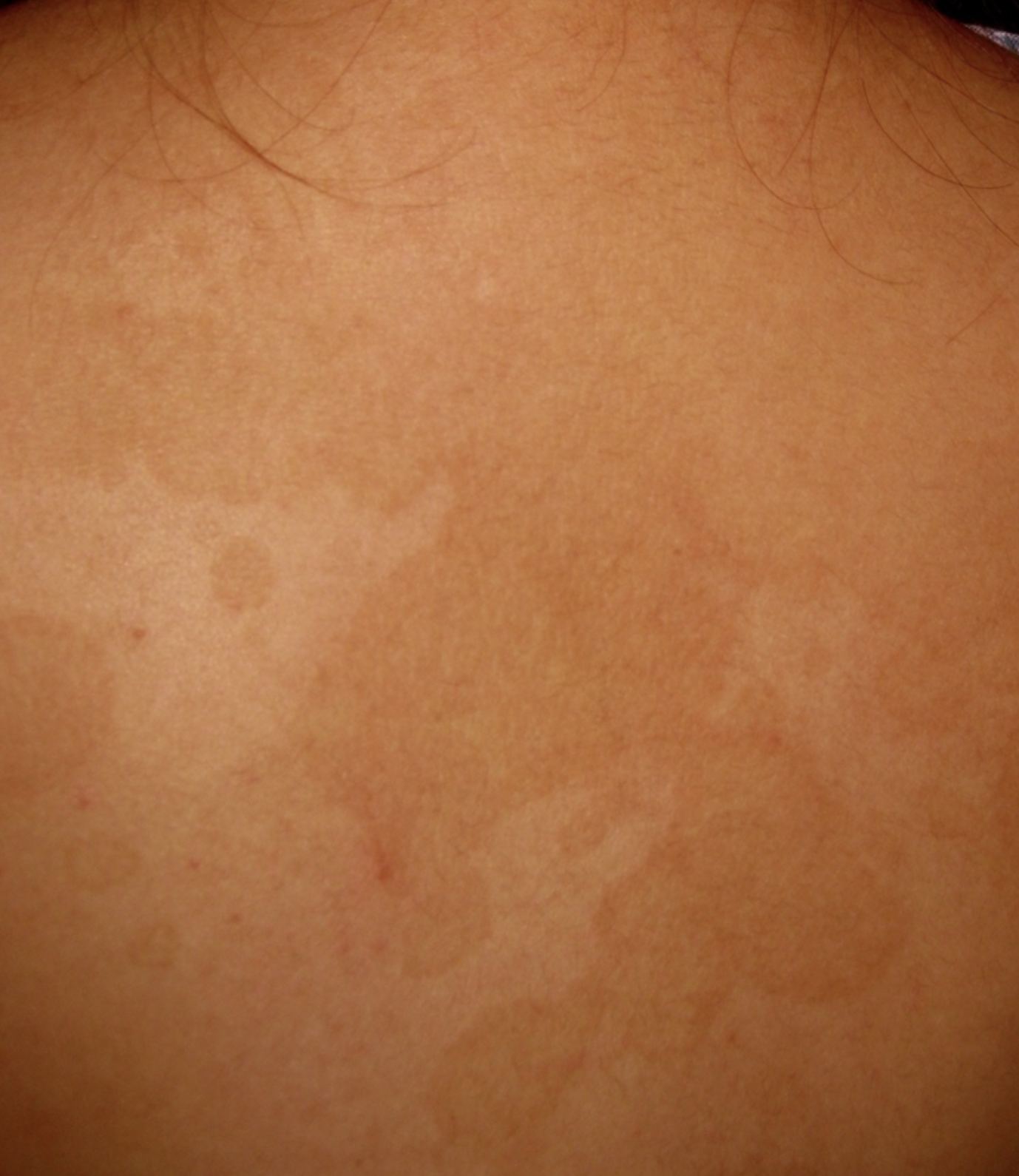 <p>Clinical , can be confirmed with Potassium Hydroxide (KOH), </p><p>The curved hyphae and round yeast cells appear as "spaghetti and meatballs" under the microscope. Topical therapy (ketoconazole, terbinafine, selenium sulfide) are the treatment of choice.</p>