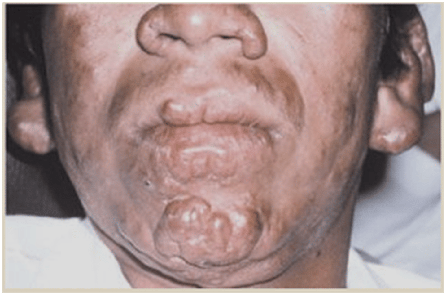 <p>Lepromatous (multibacillary) leprosy</p>