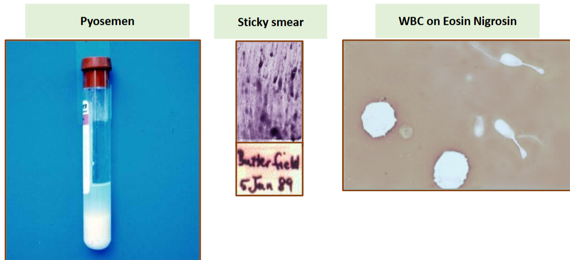 <p>Orchitis or Seminal Vesicculitis</p>