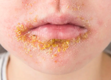 <p>Thin-walled vesicles or pustules that rupture quickly</p><p>Forming a golden-brown crust</p>