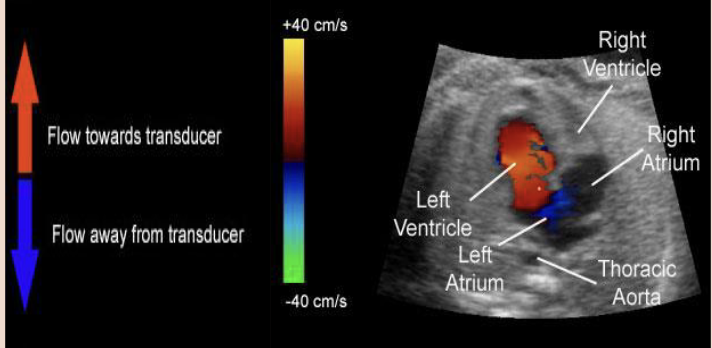 <p><span style="color: #000000"><strong>Doppler ultrasound</strong>: This technique shows how fast blood flows and in what direction.</span><span style="color: #000000"><br></span><span style="color: #000000"><strong>• Color Doppler ultrasound</strong>: This technique also shows blood flow, but it uses different colors to highlight the different directions of flow</span><span style="color: transparent">.</span></p>