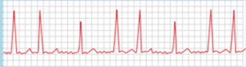 <p>what is an atrial fibrillation (AFib)?</p>