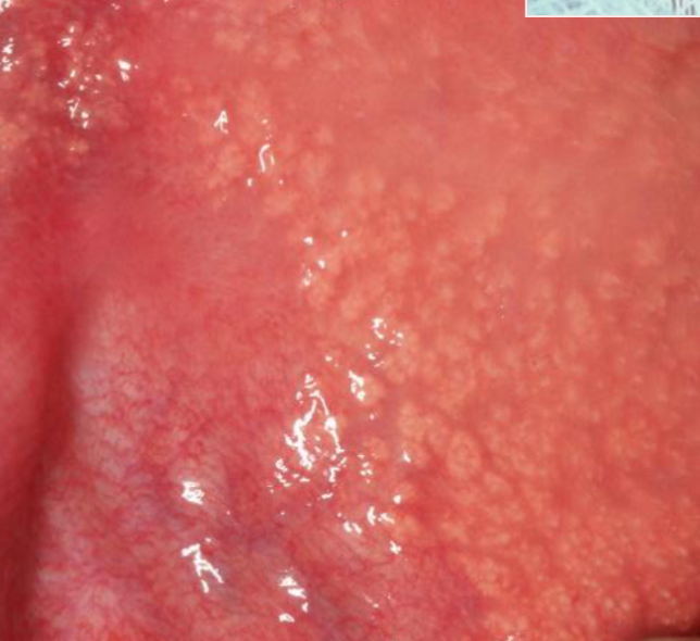 <p>clusters of ECTOPIC SEBACEOUS glands </p>