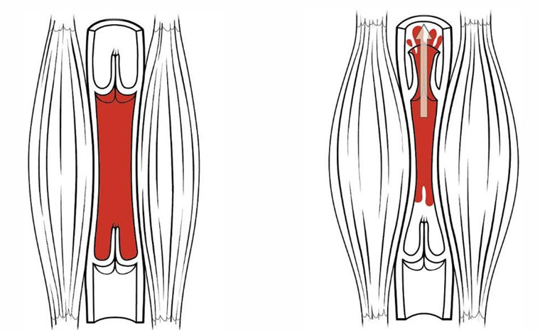 <ol><li><p>Skeletal muscle is relaxed and valves are closed</p></li><li><p>Skeletal muscle contracts and valve above open</p></li></ol><p></p>