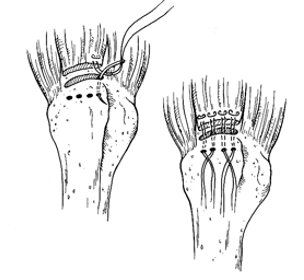 <p>Rotator Cuff Repair Mini -Open (Decreasing in use)  </p>